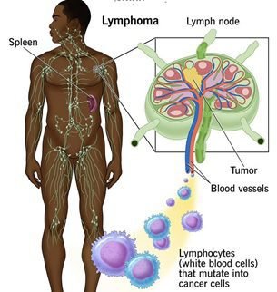 لیمفوما (Lymphoma) څه ډول ناروغي ده؟