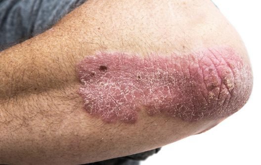 پیسورازیس (Psoriasis) څرنګه ناروغي ده؟