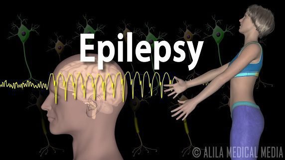 میرګي (Epilepsy)