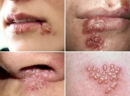 د شونډې وتل (تاوخال) یا (Herpes) څرنګه ناروغي ده؟