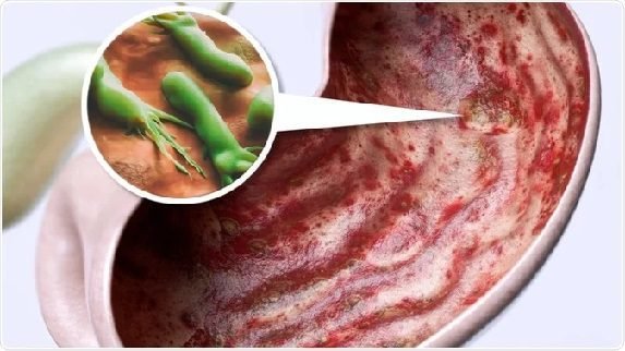 نوی انتي بیوټیک، د معدې سرطان د باکتریا ۶۰٪ مخه نیولی شي