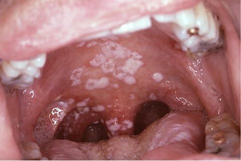  Soorösophagitis څه ډول ناروغي ده؟