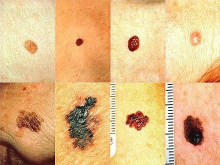 د پوستکي سرطان (Skin Cancer) | ډاکټر ش میره‌کی