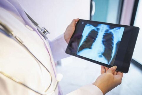 د سږو سرطان (Lung cancer) | ډاکتر رحیم هلال
