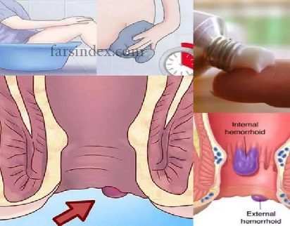 بواسیر څرنګه ناروغي ده؟ | ډاکټر ش میره‌کی