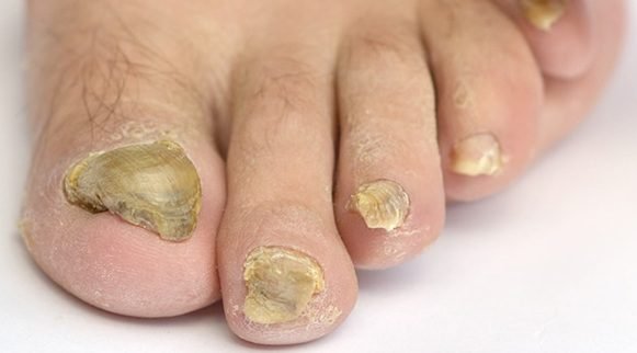 د پښو د نوکانو فنګس (Onychomycosis) څه ډول ناروغي ده؟