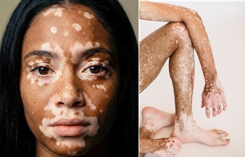 پیس (Vitiligo) څرنګه ناروغي ده؟